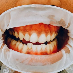 Can I Have a Teeth Whitening With Gum Disease?