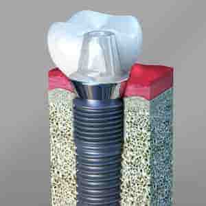 Dental Implants: Categories, Procedures, and Cost | Antioch