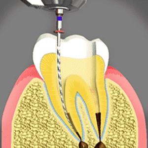 Is Root Canal Counted as a Dental Emergency?