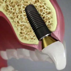 Gum Disease: Candidate for Dental Implants