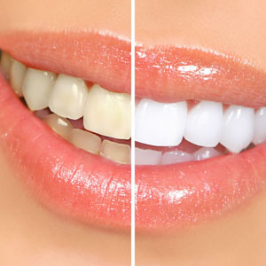How Professional Teeth Whitening Is Done? | Pittsburg