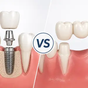 Helpful dental information about dental implants in Brentwood