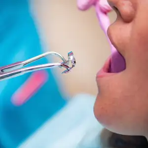 Mistakes to Avoid After Tooth Extraction in Pittsburg