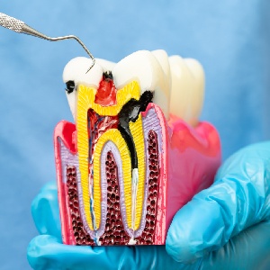 Myths and Facts About Root Canal in Brentwood Myths and Facts About Root Canal in Brentwood