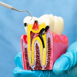 Recovery Tips After a Root Canal in Brentwood