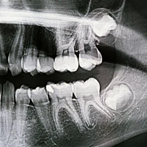 Panoramic dental X-ray showing an impacted lower wisdom tooth and surrounding molars, commonly evaluated for wisdom teeth removal in Brentwood.