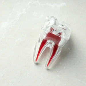 Dental model representing root canal in Pittsburg treatment for infected tooth pulp