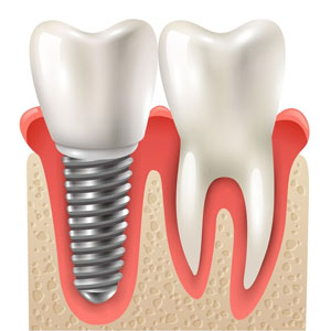 Should Endodontists Place Dental Implants in Brentwood?
