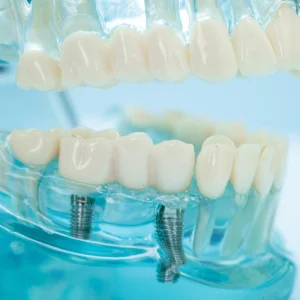 Dental model showing implant screws and replacement teeth for dental implants in Pittsburg.