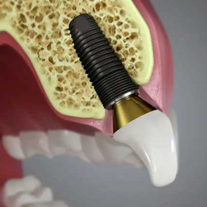 The Span of Dental Implants Treatment | Antioch | Pittsburg