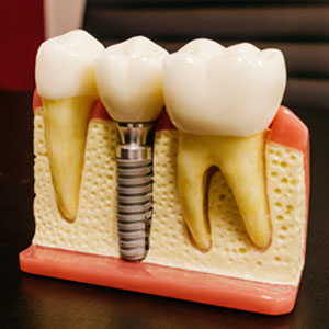 Throwing Light on Dental Implants | Antioch, CA