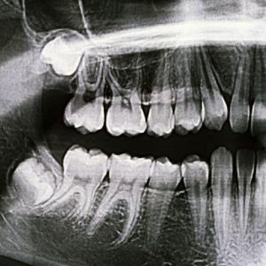 Top 5 Signs You May Need Wisdom Teeth Removal in Pittsburg