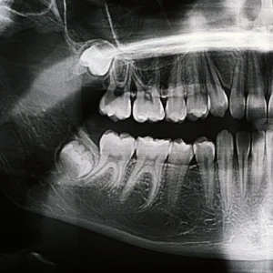 Panoramic dental X-ray showing wisdom teeth removal in Brentwood evaluation