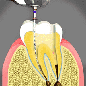 Root Canal Treatments in Antioch, CA