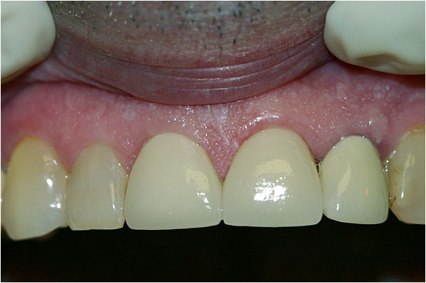 Lava Crowns After2 