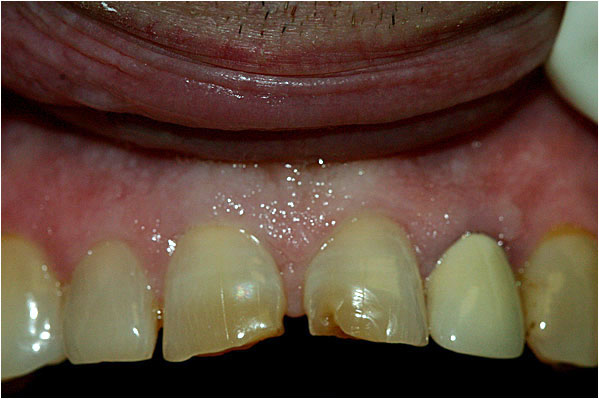 Lava Crowns Before2